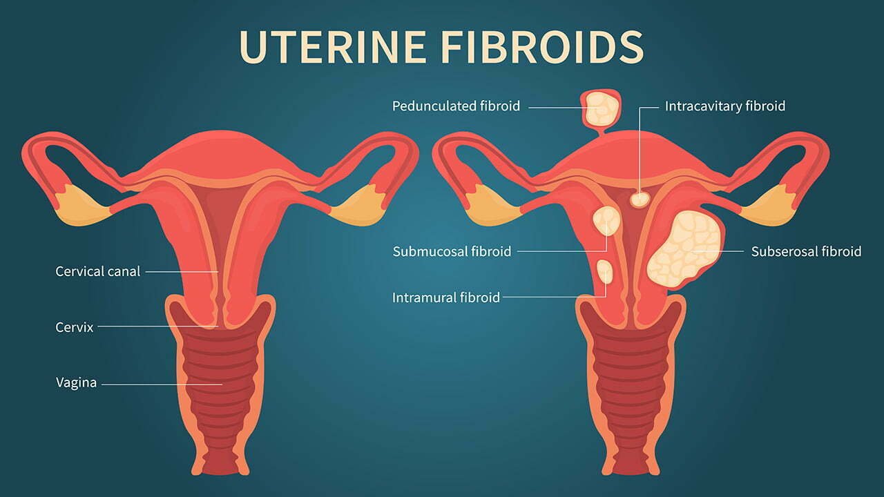 uterine fibroid