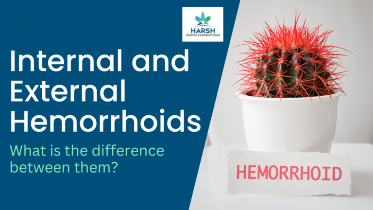 Internal Vs External Hemorrhoids Whats The Difference - Otosection