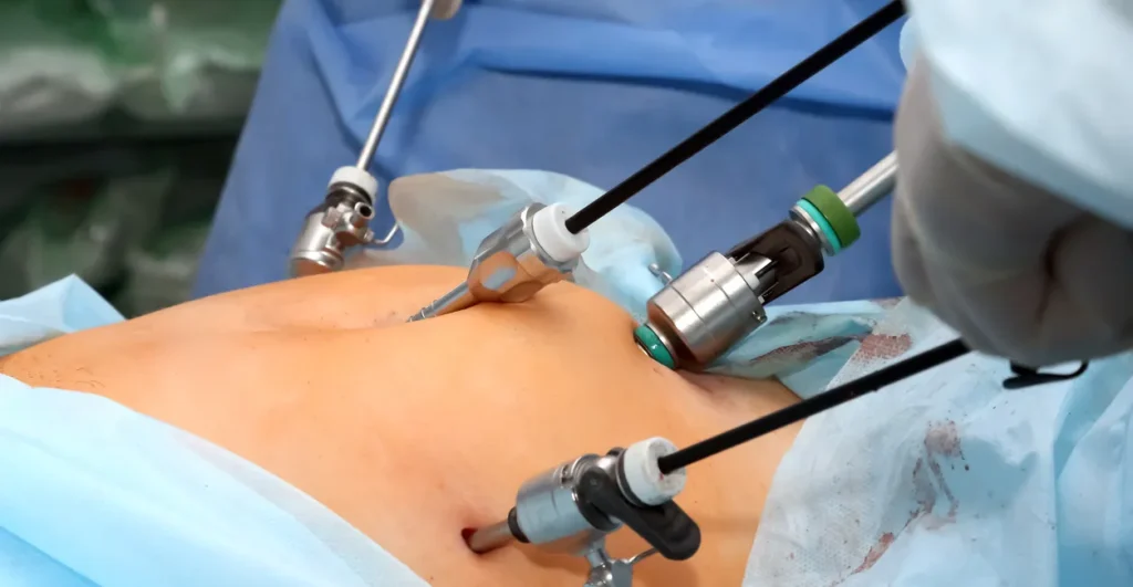 Best Endometriosis Treatment in Surat